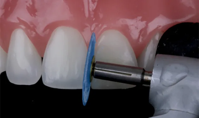 تشكيل حشو تجميلي على السن